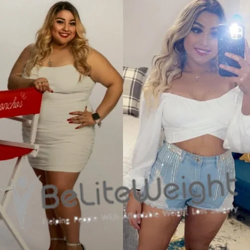 Weight Loss Surgery Before And After